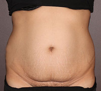 Abdominoplasty (Tummy Tuck) Before & After Gallery - Patient 106984990 - Image 1