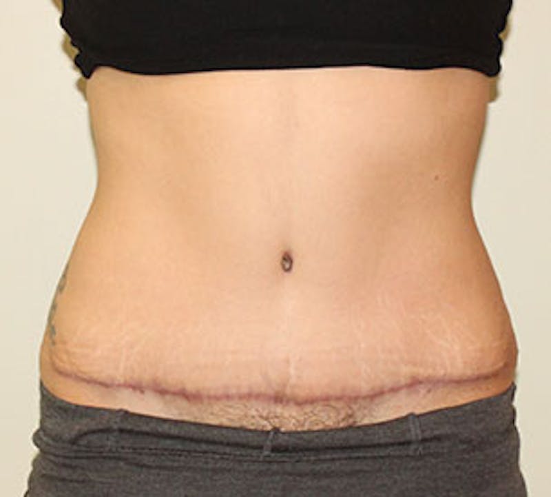 Abdominoplasty (Tummy Tuck) Before & After Gallery - Patient 106984990 - Image 2