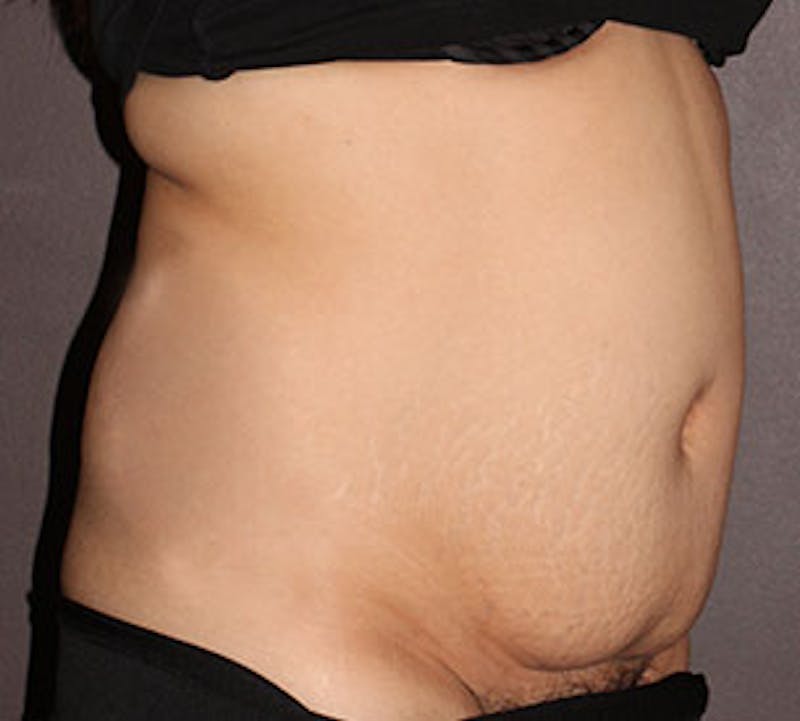 Abdominoplasty (Tummy Tuck) Before & After Gallery - Patient 106984990 - Image 3