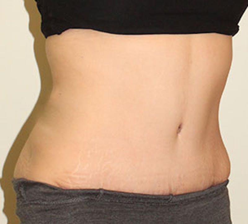 Abdominoplasty (Tummy Tuck) Before & After Gallery - Patient 106984990 - Image 4