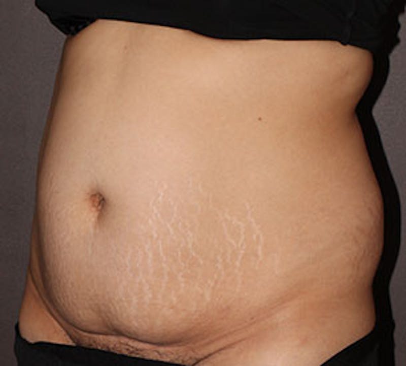 Abdominoplasty (Tummy Tuck) Before & After Gallery - Patient 106984990 - Image 5