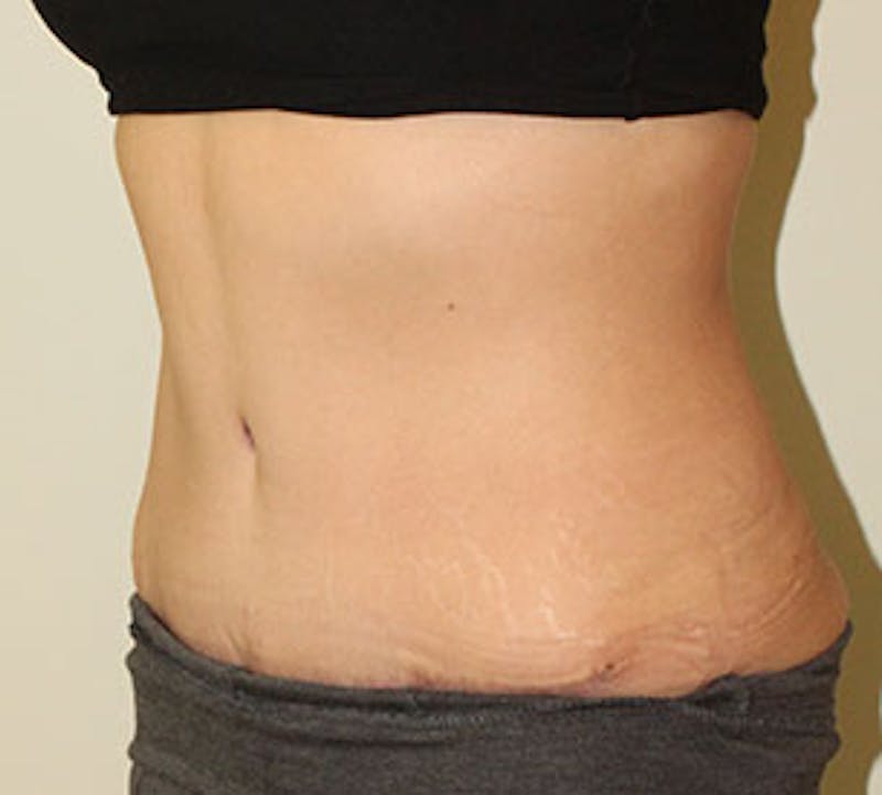 Abdominoplasty (Tummy Tuck) Before & After Gallery - Patient 106984990 - Image 6