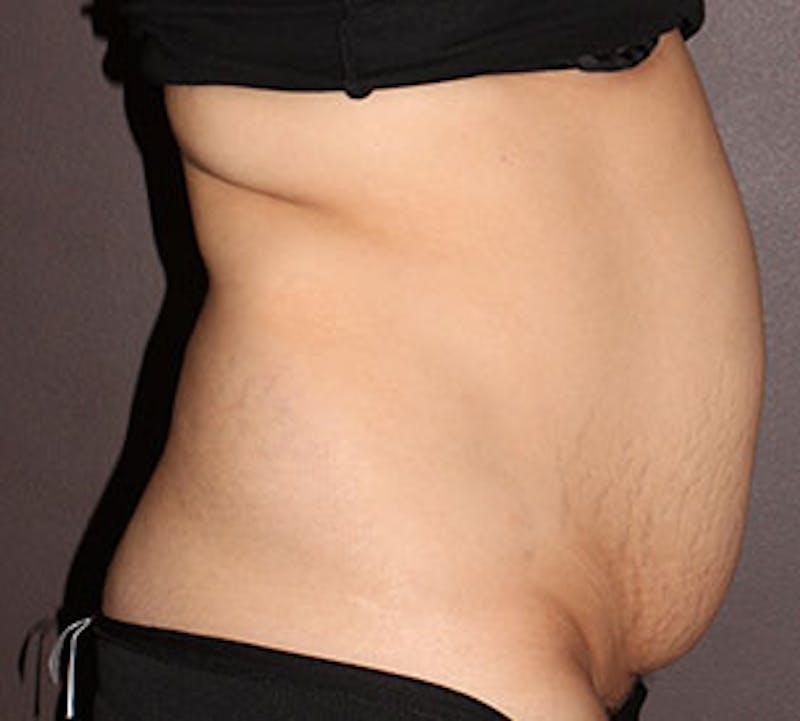 Abdominoplasty (Tummy Tuck) Before & After Gallery - Patient 106984990 - Image 7