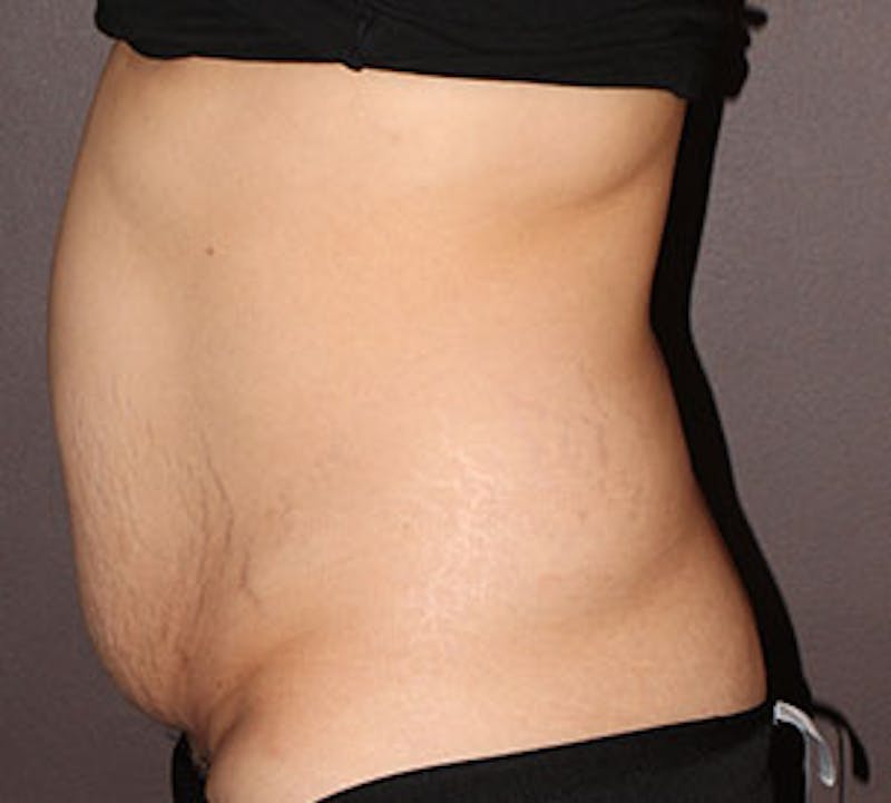 Abdominoplasty (Tummy Tuck) Before & After Gallery - Patient 106984990 - Image 9