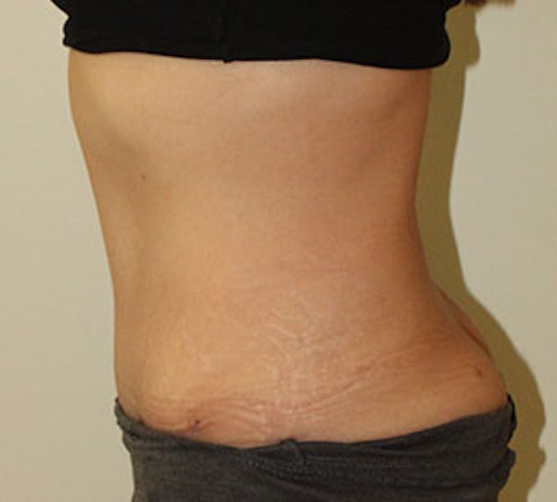 Abdominoplasty (Tummy Tuck) Before & After Gallery - Patient 106984990 - Image 10