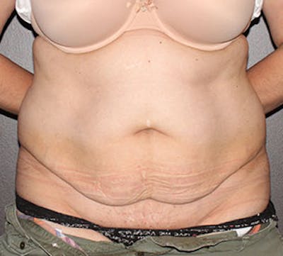 Abdominoplasty (Tummy Tuck) Before & After Gallery - Patient 106984997 - Image 1