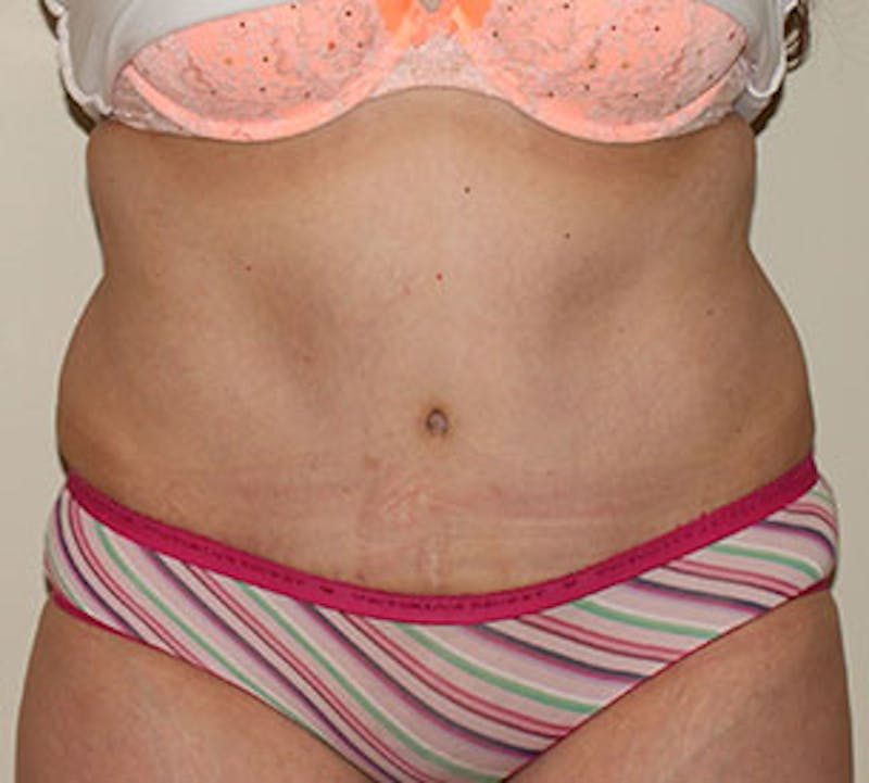 Abdominoplasty (Tummy Tuck) Before & After Gallery - Patient 106984997 - Image 2