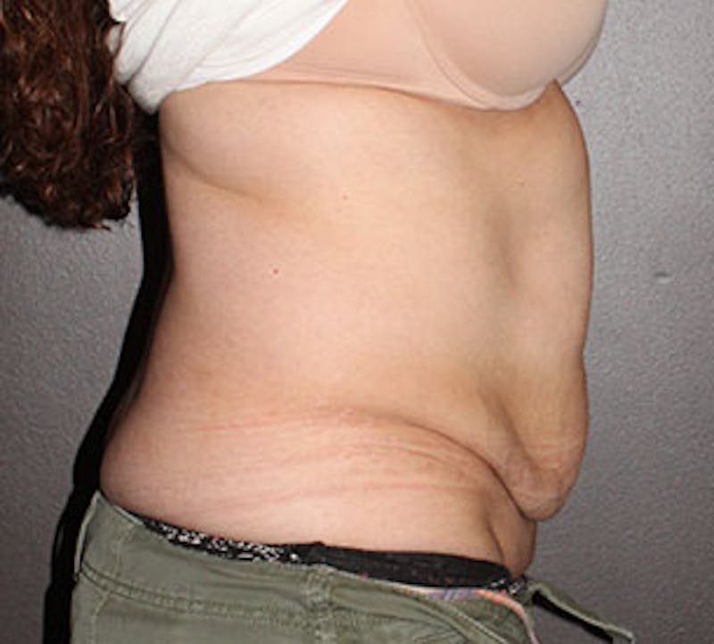 Abdominoplasty (Tummy Tuck) Before & After Gallery - Patient 106984997 - Image 7