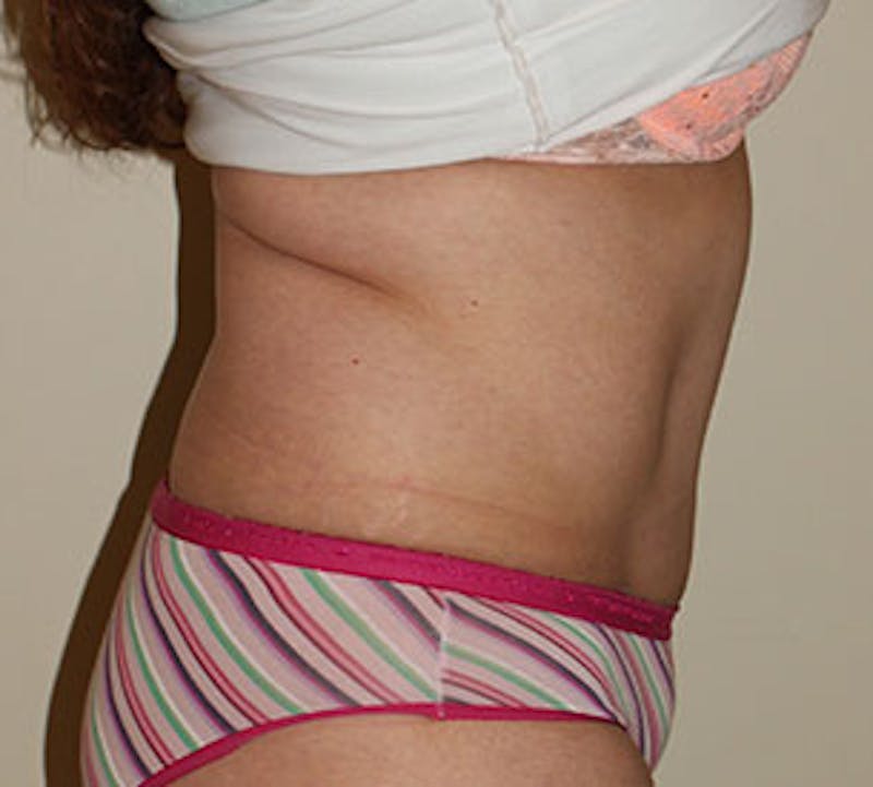 Abdominoplasty (Tummy Tuck) Before & After Gallery - Patient 106984997 - Image 8