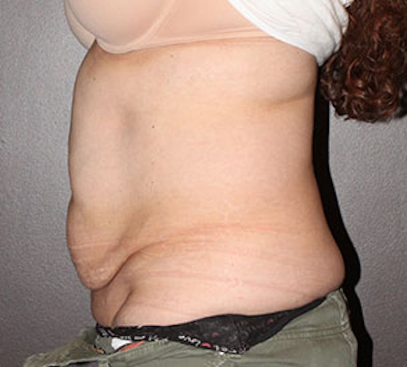 Abdominoplasty (Tummy Tuck) Gallery - Patient 106984997 - Image 9