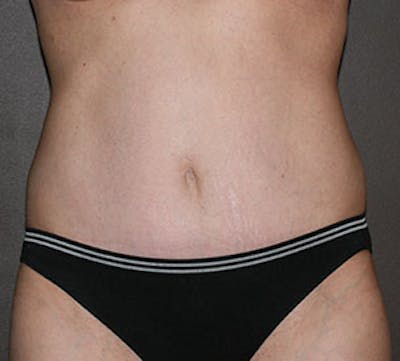Abdominoplasty (Tummy Tuck) Before & After Gallery - Patient 106985003 - Image 2