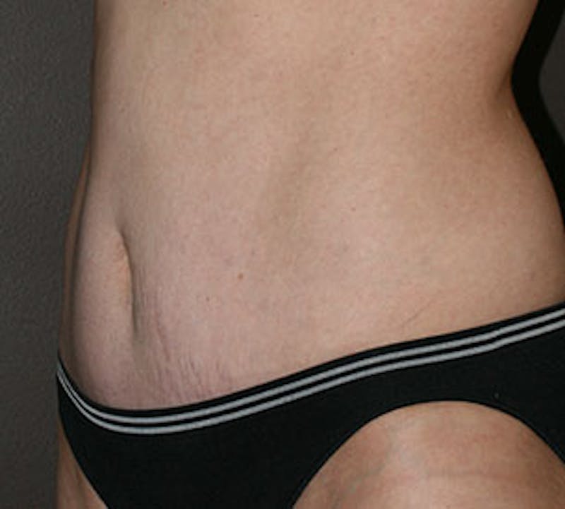 Abdominoplasty (Tummy Tuck) Before & After Gallery - Patient 106985003 - Image 6
