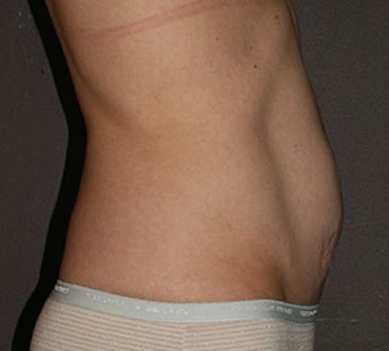 Abdominoplasty (Tummy Tuck) Before & After Gallery - Patient 106985003 - Image 7