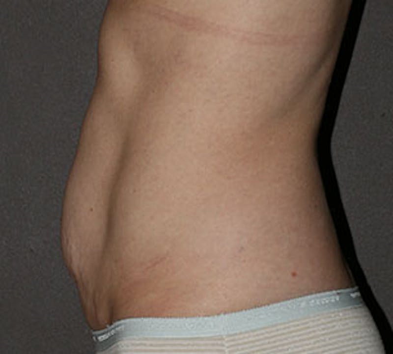 Abdominoplasty (Tummy Tuck) Before & After Gallery - Patient 106985003 - Image 9