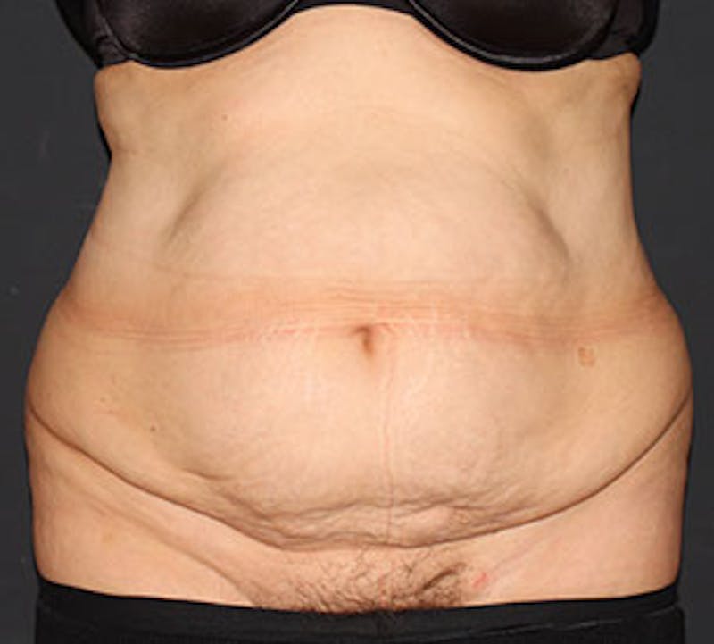 Abdominoplasty (Tummy Tuck) Before & After Gallery - Patient 106985034 - Image 1