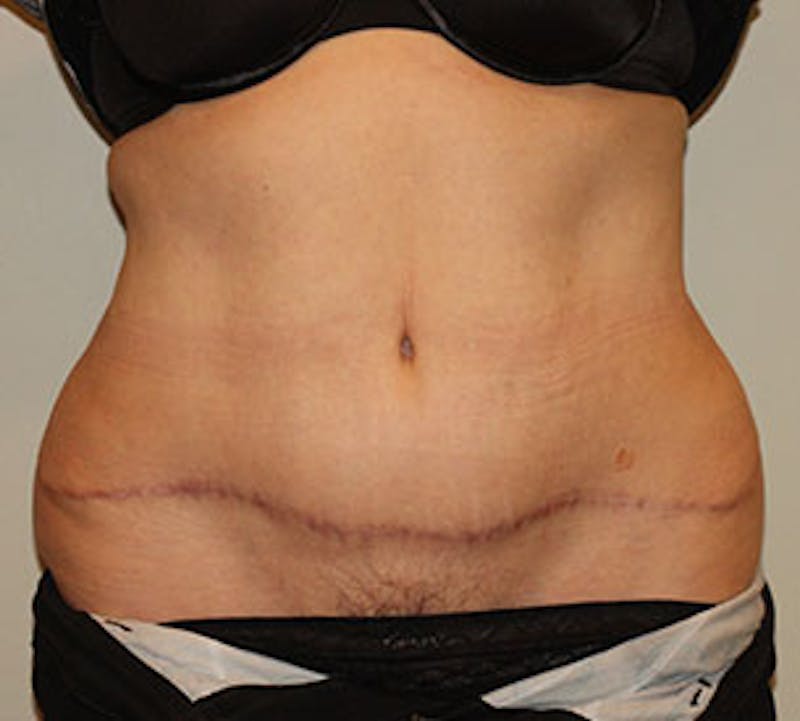 Abdominoplasty (Tummy Tuck) Before & After Gallery - Patient 106985034 - Image 2