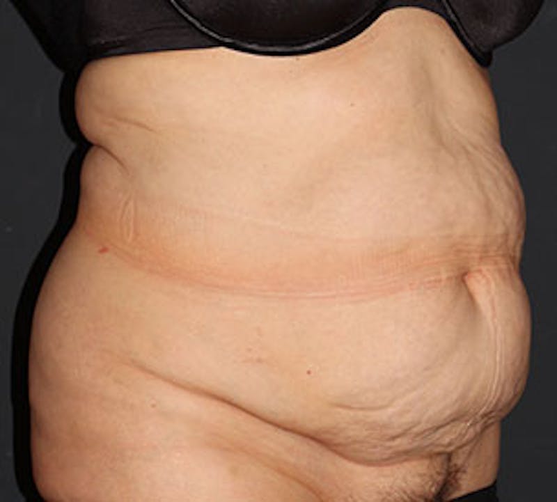 Abdominoplasty (Tummy Tuck) Before & After Gallery - Patient 106985034 - Image 3