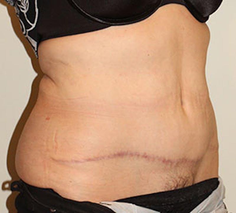 Abdominoplasty (Tummy Tuck) Before & After Gallery - Patient 106985034 - Image 4