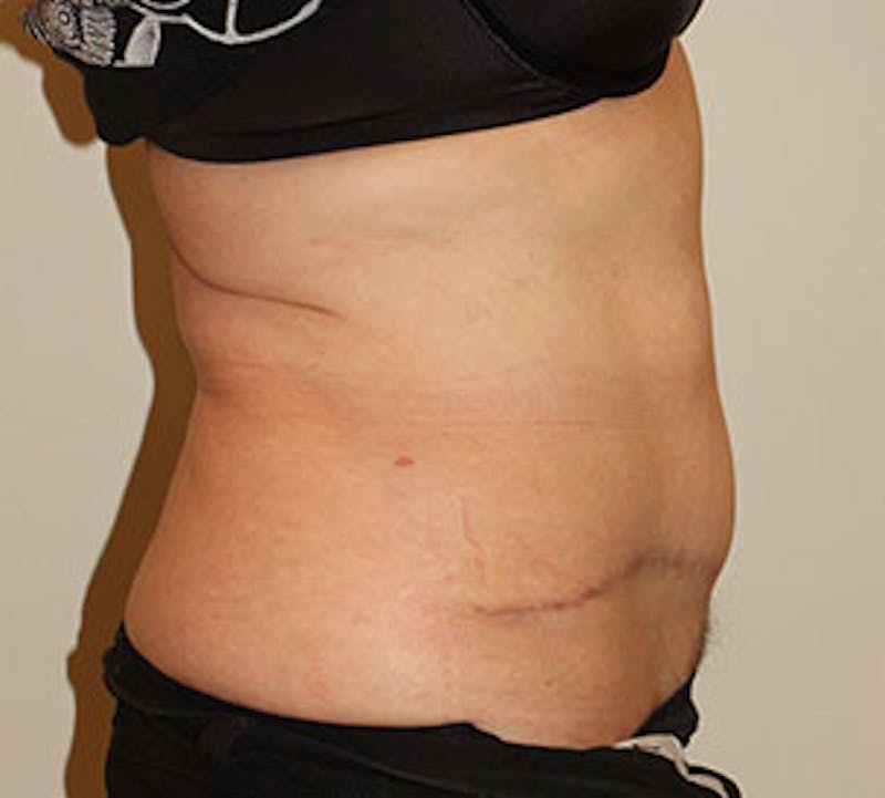 Abdominoplasty (Tummy Tuck) Gallery - Patient 106985034 - Image 8