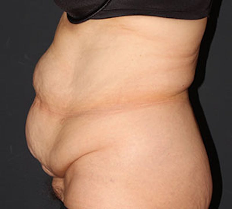 Abdominoplasty (Tummy Tuck) Before & After Gallery - Patient 106985034 - Image 9