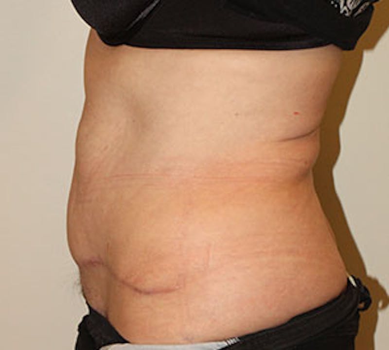 Abdominoplasty (Tummy Tuck) Before & After Gallery - Patient 106985034 - Image 10