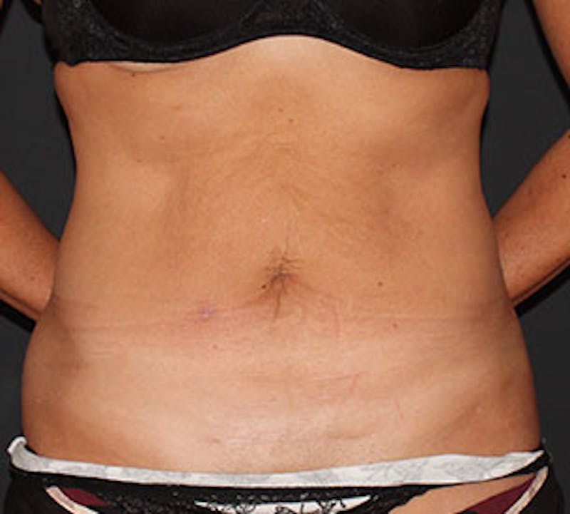 Abdominoplasty (Tummy Tuck) Before & After Gallery - Patient 106985047 - Image 1