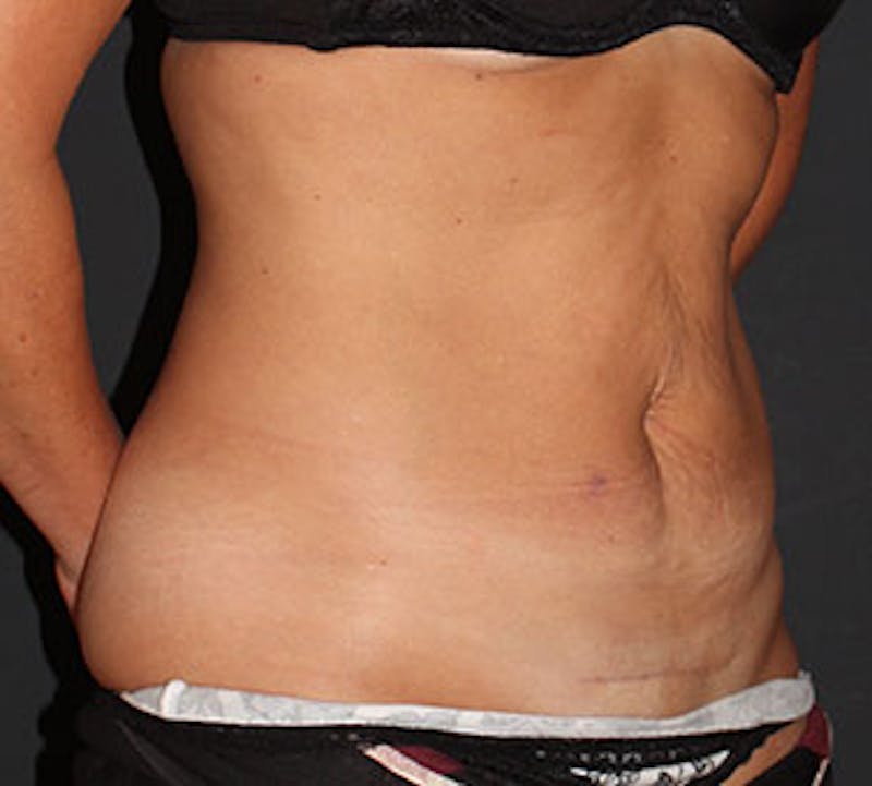 Abdominoplasty (Tummy Tuck) Before & After Gallery - Patient 106985047 - Image 3