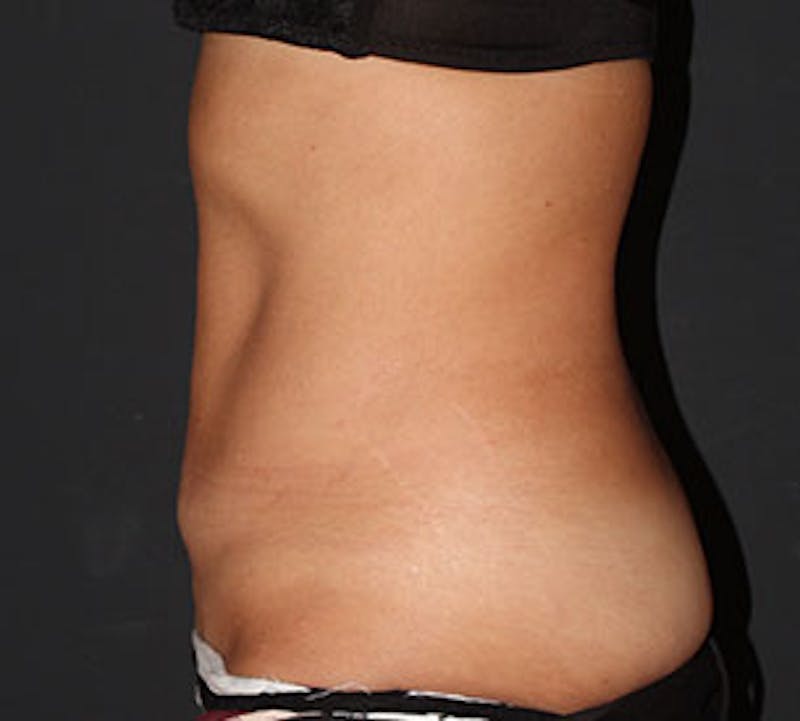 Abdominoplasty (Tummy Tuck) Before & After Gallery - Patient 106985047 - Image 9