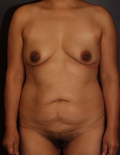 Mommy Makeover Gallery - Patient 106985246 - Image 1