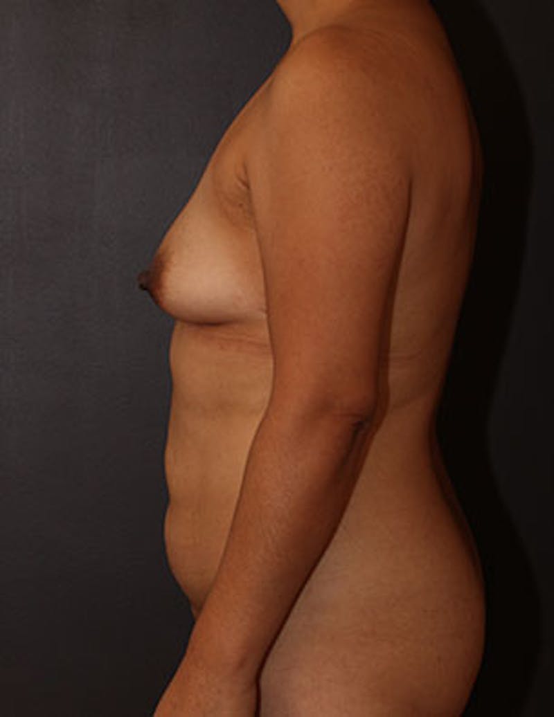 Mommy Makeover Gallery - Patient 106985246 - Image 9