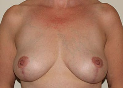 Mommy Makeover Gallery - Patient 106985314 - Image 2