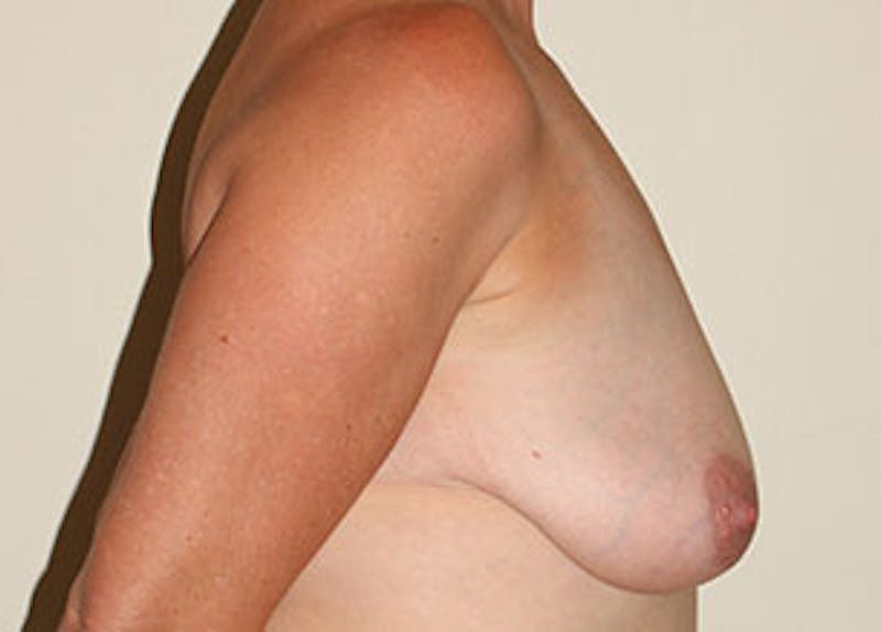 Mommy Makeover Before & After Gallery - Patient 106985314 - Image 13