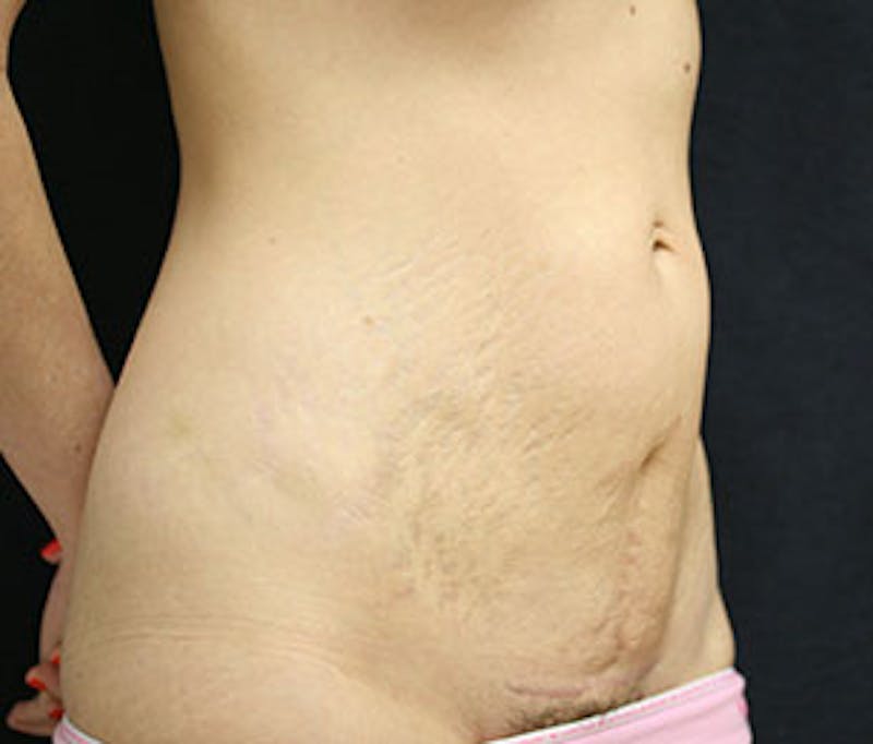 Mommy Makeover Before & After Gallery - Patient 106985347 - Image 7