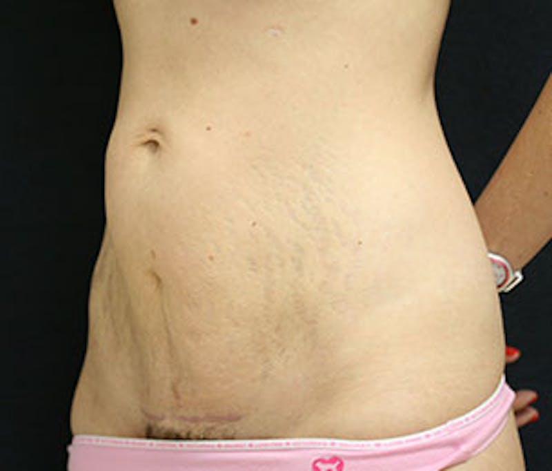 Mommy Makeover Before & After Gallery - Patient 106985347 - Image 11