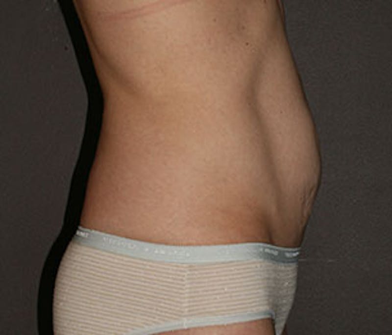 Mommy Makeover Before & After Gallery - Patient 106985363 - Image 15