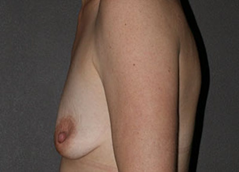 Mommy Makeover Gallery - Patient 106985363 - Image 17