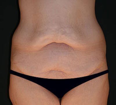 After Weight Loss Before & After Gallery - Patient 106985462 - Image 1