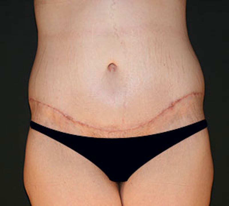 After Weight Loss Gallery - Patient 106985462 - Image 2