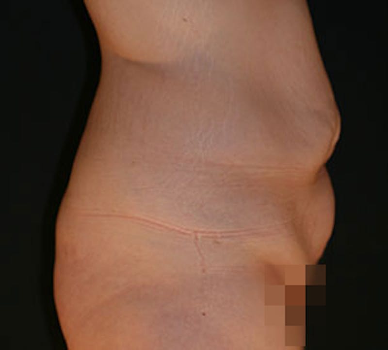 After Weight Loss Before & After Gallery - Patient 106985462 - Image 3