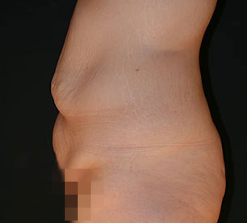 After Weight Loss Gallery - Patient 106985462 - Image 5