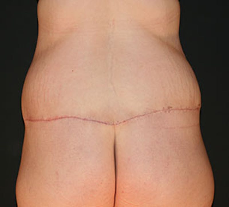 After Weight Loss Gallery - Patient 106985462 - Image 8