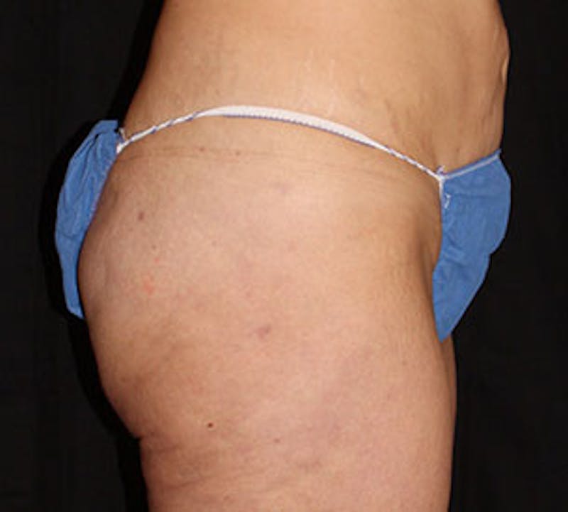 After Weight Loss Before & After Gallery - Patient 106985483 - Image 7