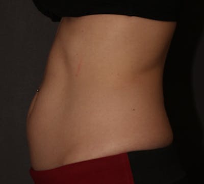 CoolSculpting® Before & After Gallery - Patient 106986106 - Image 1