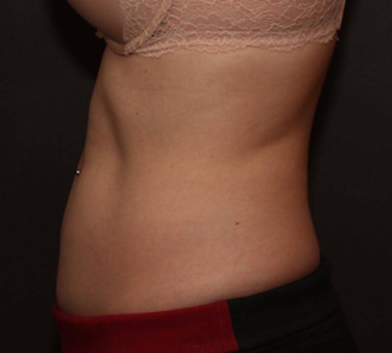 CoolSculpting® Gallery - Patient 106986106 - Image 2