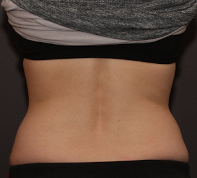 CoolSculpting® Before & After Gallery - Patient 106986106 - Image 3