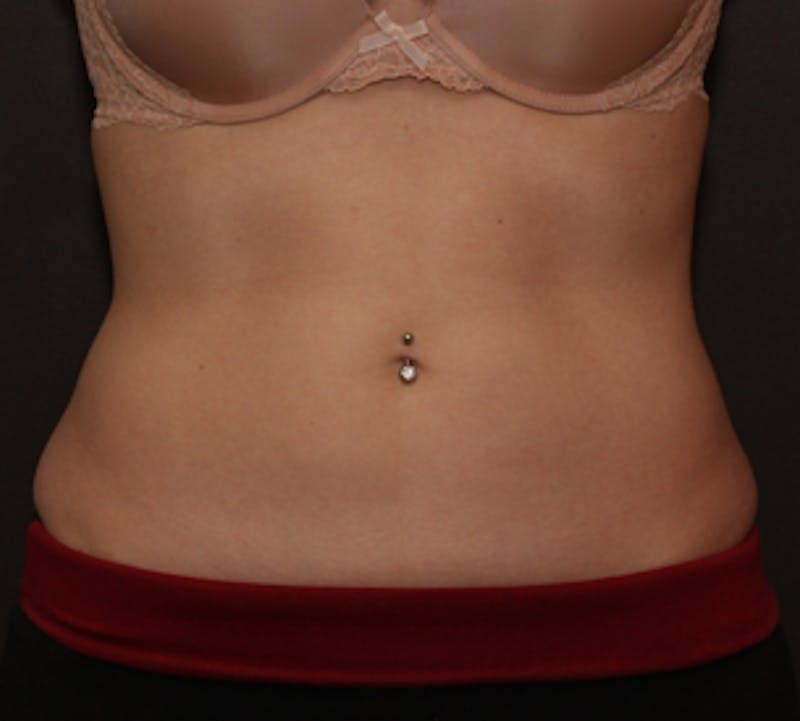 CoolSculpting® Before & After Gallery - Patient 106986106 - Image 6