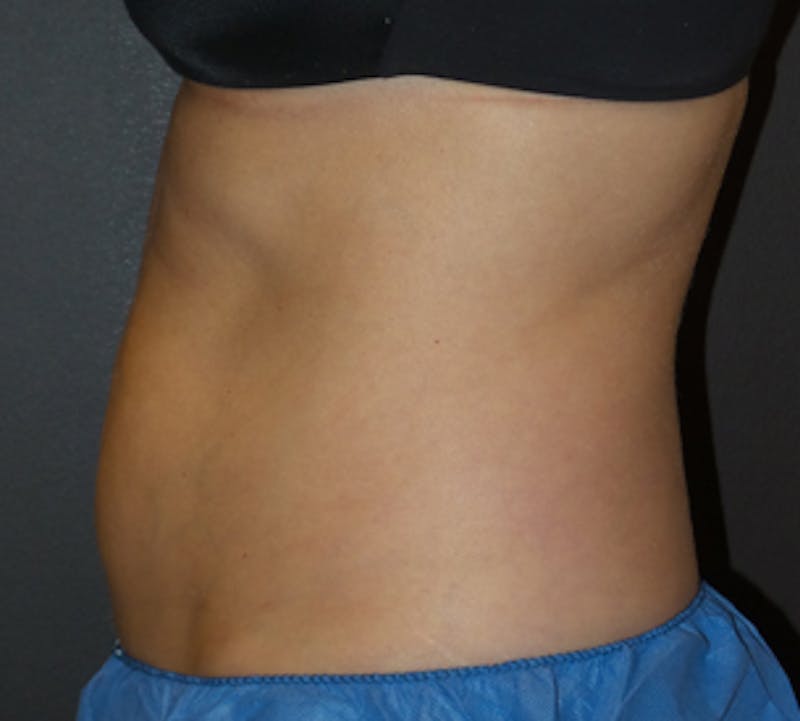CoolSculpting® Before & After Gallery - Patient 106986113 - Image 1