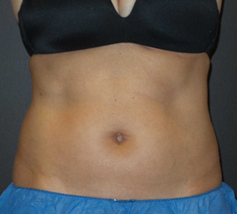 CoolSculpting® Before & After Gallery - Patient 106986113 - Image 5