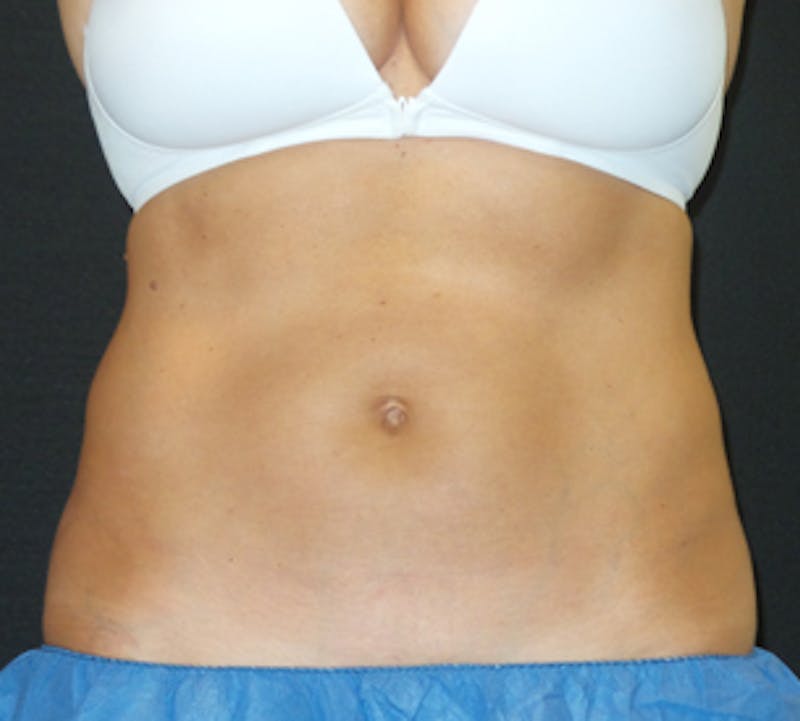 CoolSculpting® Before & After Gallery - Patient 106986113 - Image 6