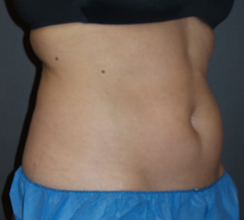CoolSculpting® Before & After Gallery - Patient 106986113 - Image 7
